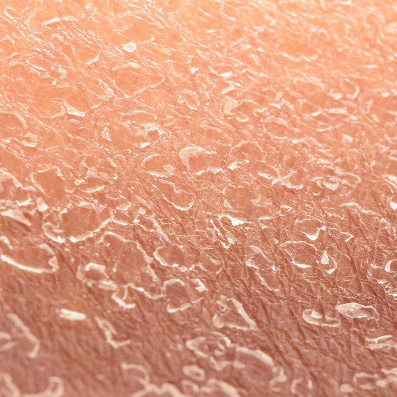 Dry, Tight-Feeling Skin